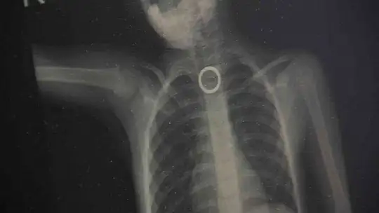 Oyun oynarken yerdeki yüzüğü yutan 3 yaşındaki çocuk ölümden döndü