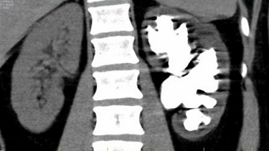 Böbreğinde 13 santimlik taş tespit edilen hasta, kapalı ameliyatla sağlığına kavuştu