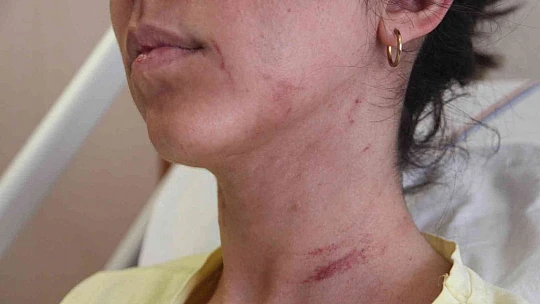 Doktor sevgilisinin evinde dehşeti yaşayan genç kadın 2 saat boyunca darp edildi, 5 yerinden bıçaklandı