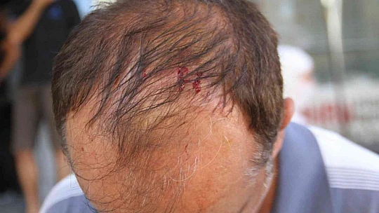 Ekmek sırası beklerken başına düşen cam parçaları ile yaralandı