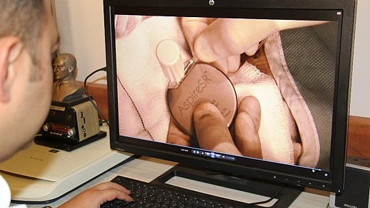 Epilepsi pili operasyonu sara hastalarının umudu oldu