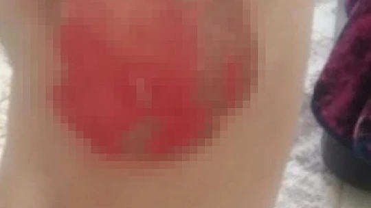 Eşinden dayak yiyip üzerine kaynar su dökülen kadından feryat: 'Ölmek istemiyorum'