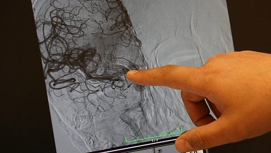 Her 6 saniyede 1 kişi inme geçiriyor, saatte 1 kişi hayatını kaybediyor