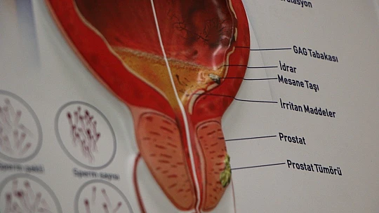 İç yağ, hayvansal yağ tüketen ve sigara içenlerde prostat kanseri daha çok görülüyor