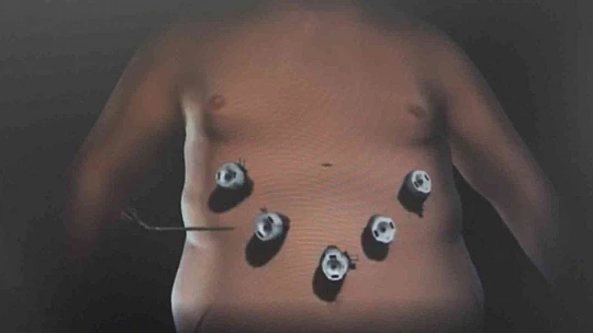 Obeziteye bağlı ölümler sigara nedenli ölümleri geride bıraktı