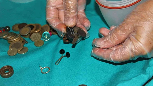 Para, pul, iğne, yüzük: Bu midelerde ne ararsanız var