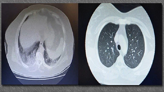 Koronavirüse yakalanan hastaların ciğerlerindeki dehşet veren görüntü